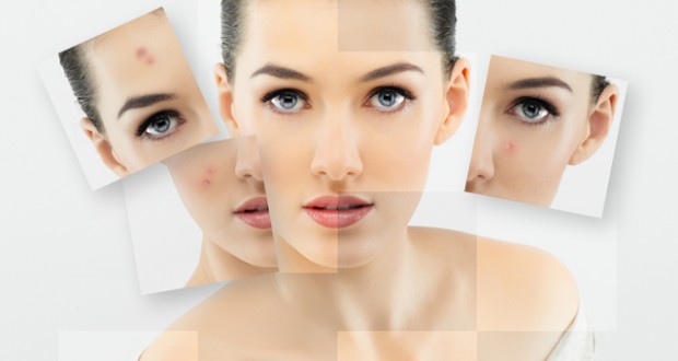 acne cure acne treatment in Noida