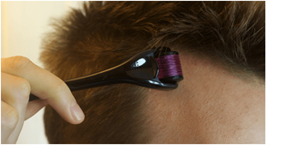 derma roller treatment in noida