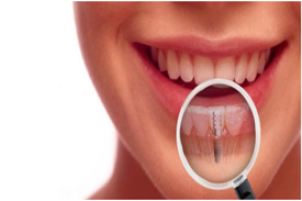 dental implants dental implants treatment
