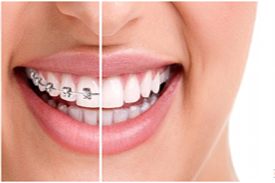 Orthodontic treatment