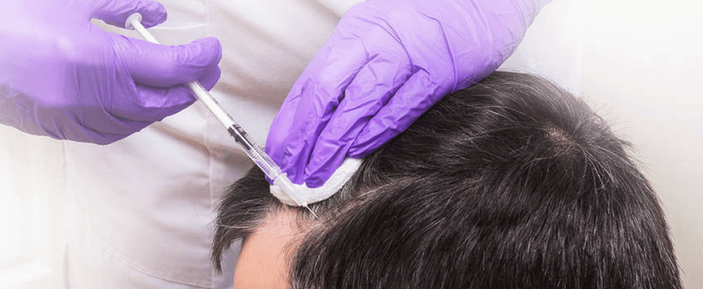 prp treatment injecting needle on head